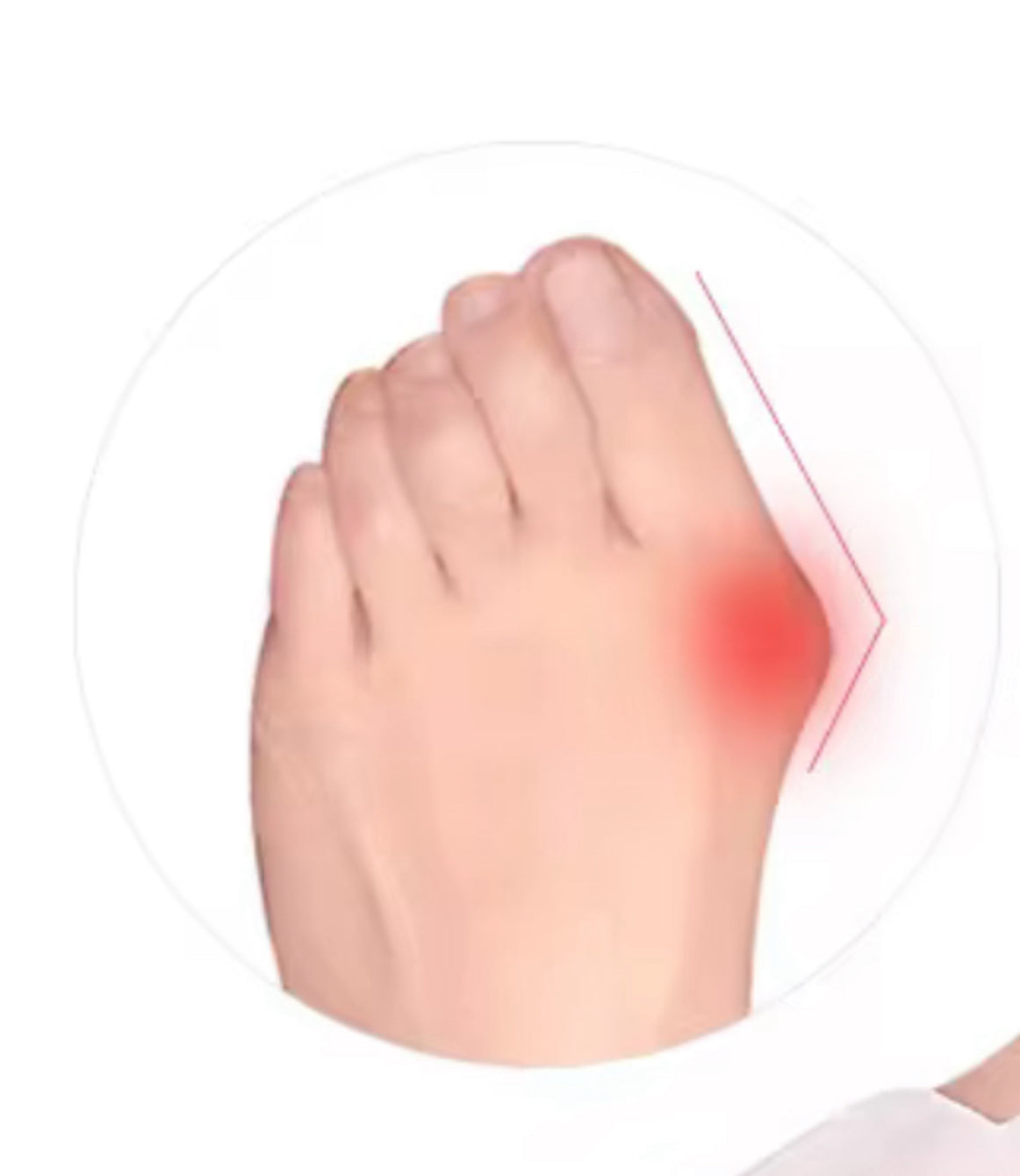 Séparateur d’orteils correcteur – Soulage, aligne et protège